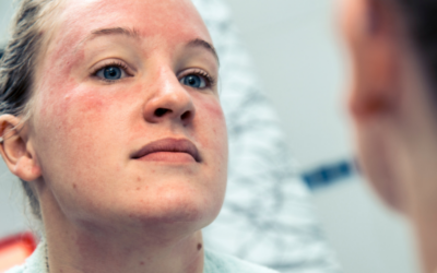 Tips for Living with Psoriasis and Eczema