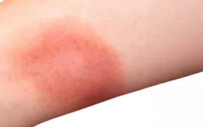 How to Treat and Prevent Scarring