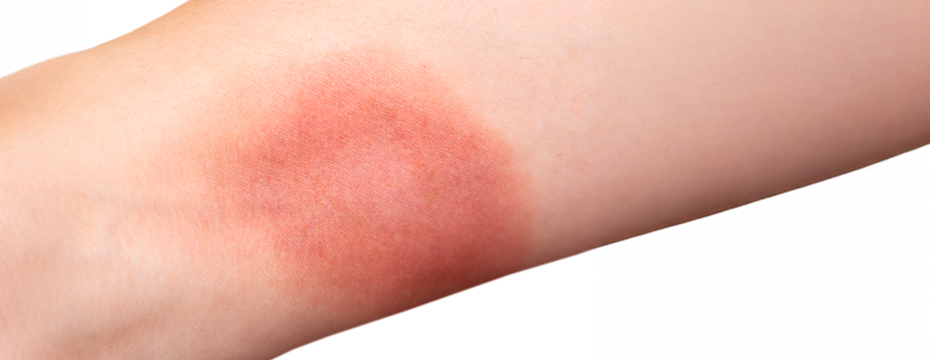 How to Treat and Prevent Scarring How to Treat and Prevent Scarring