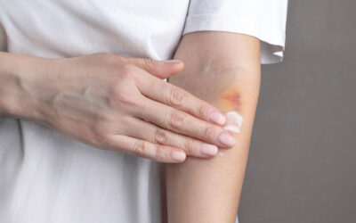 The Role of Antiseptics in Wound Care: What Works and What Doesn’t