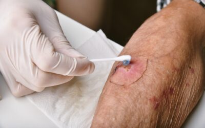 Hydrogel dressings: benefits and applicability for wound healing